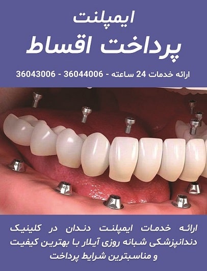 پرداخت اقساط ایمپلنت دندان - کلینیک دندانپزشکی آیلار - دکتر افشین بهارفر
