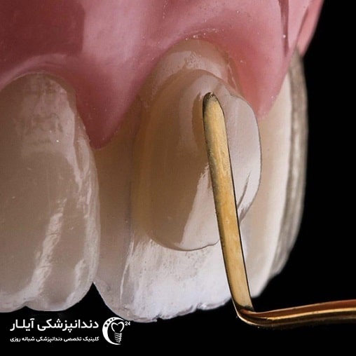کامپوزیت ونیر در دندانپزشکی آیلار پاکدشت