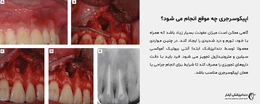 درمان ریشه دندان در پاکدشت - دندانپزشکی آیلار پاکدشت