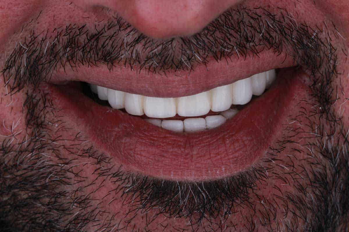 نمونه کار ایمپلنت دندان آیلار - دندانپزشکی در پاکدشت
