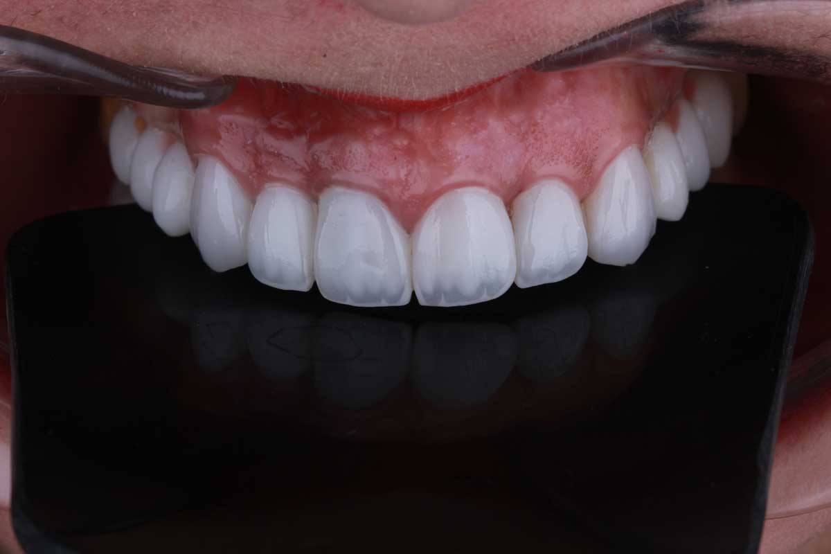نمونه کار لمینت دندان آیلار - دندانپزشکی در پاکدشت