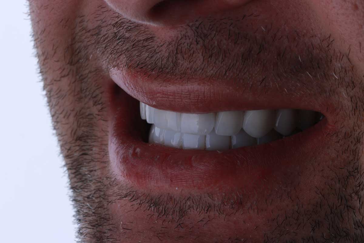 نمونه کار لمینت دندان آیلار - دندانپزشکی در پاکدشت