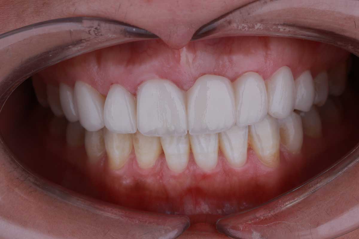 نمونه کار کامپوزیت دندان آیلار - دندانپزشکی در پاکدشت