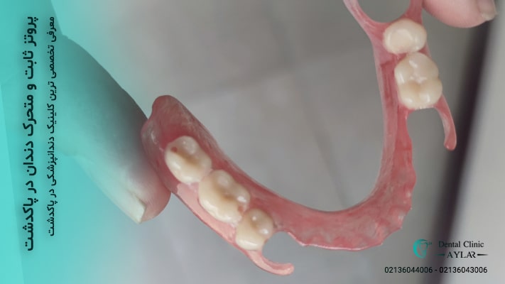 پروتز ثابت و متحرک دندان در پاکدشت - دندانپزشکی آیلار